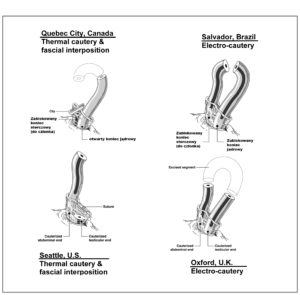 no-scalpel vasectomy